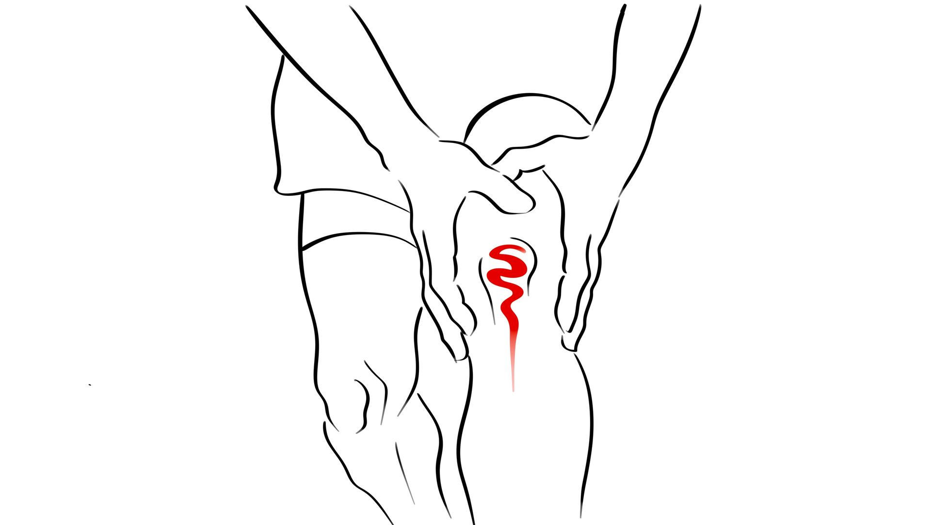 Die Illustration zeigt ein Knie mit Arthrose