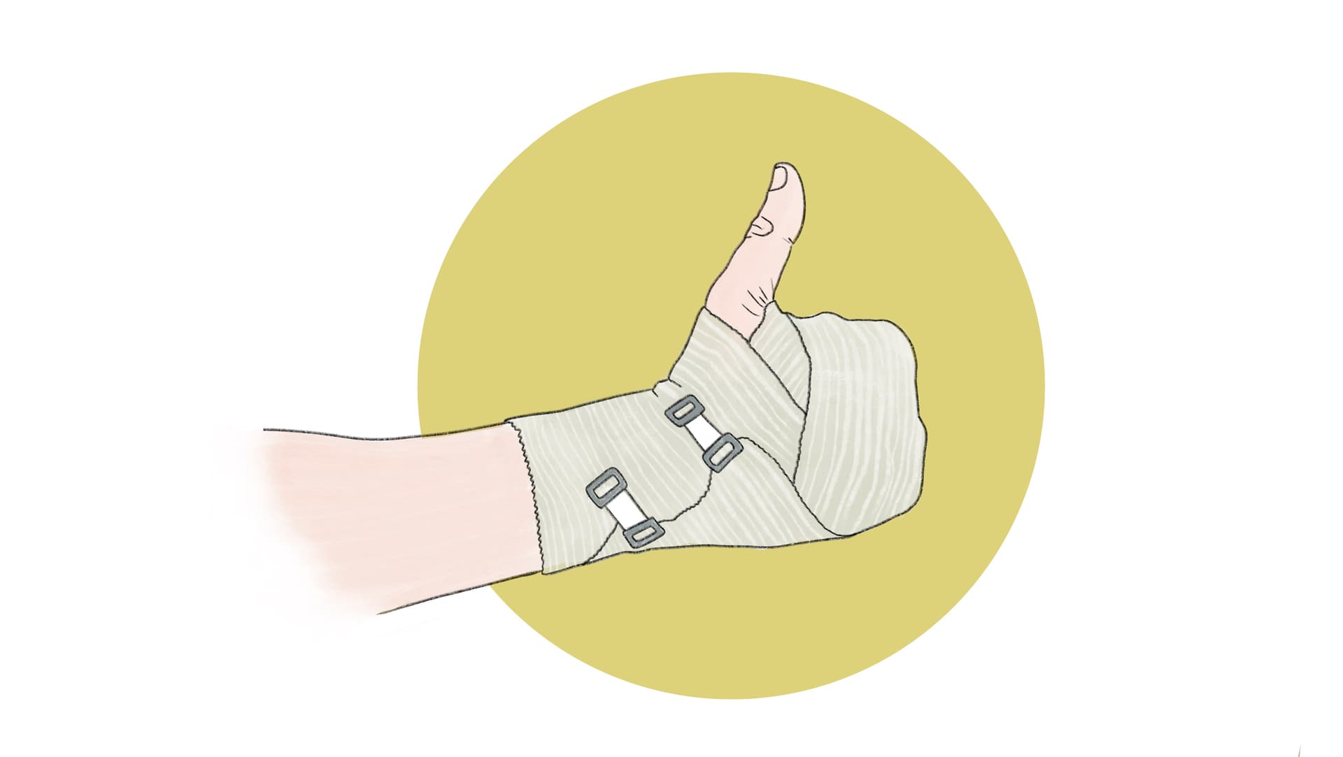 Die Hand ist ein äußerst komplexes Organ, bei dem selbst kleine Verletzungen oder Veränderungen zu erheblichen Funktionsstörungen führen können. Die Illustration zeigt eine Hand mit einem Verband.