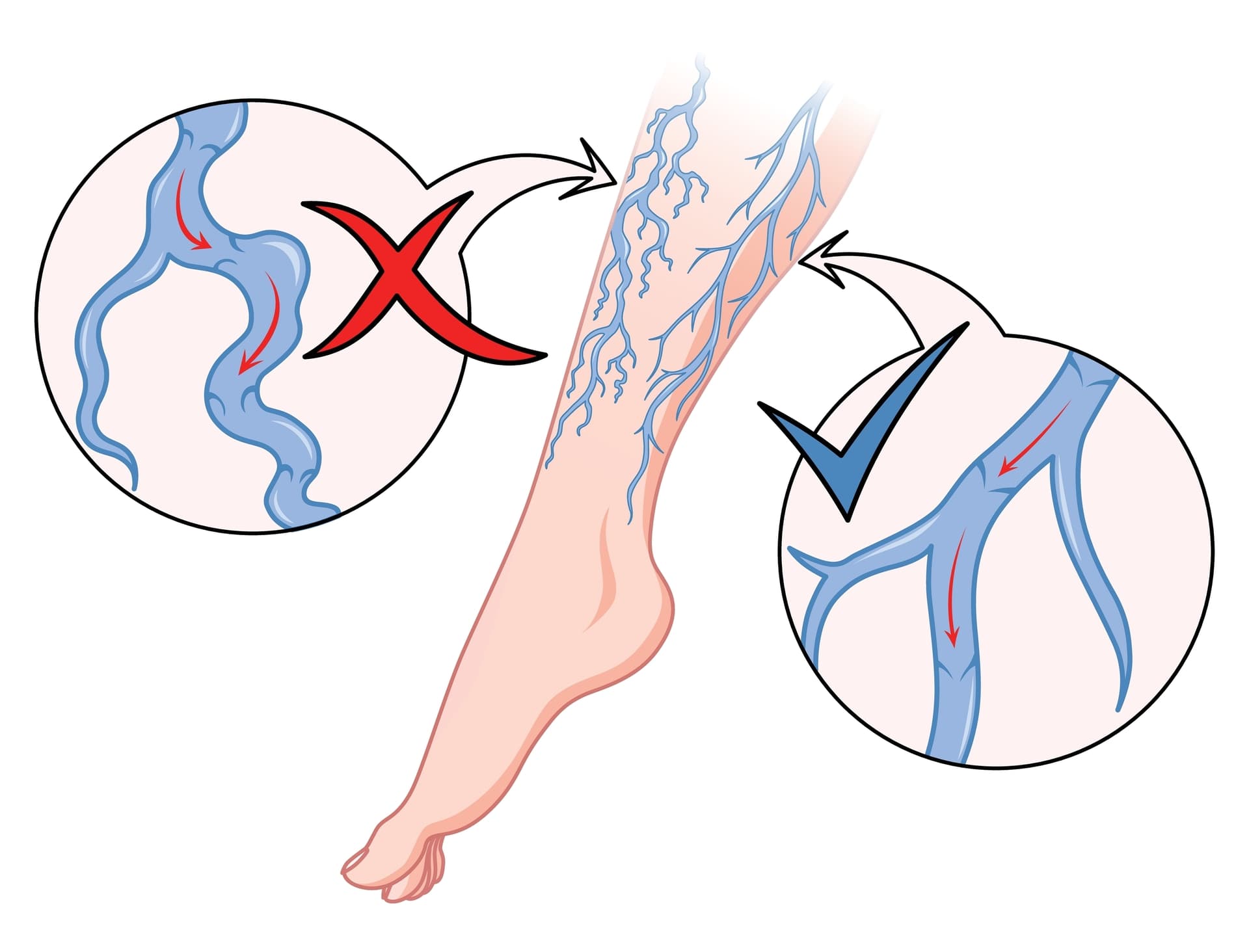 Gefäßmediziner nutzen klinische Untersuchungen und Ultraschall für Diagnosen. Endovaskuläre Interventionen ermöglichen minimal-invasive Behandlungen, oft unter örtlicher Betäubung. Die Illustration zeigt Krampfadern und eine Durchblutungsstörung im Bein.