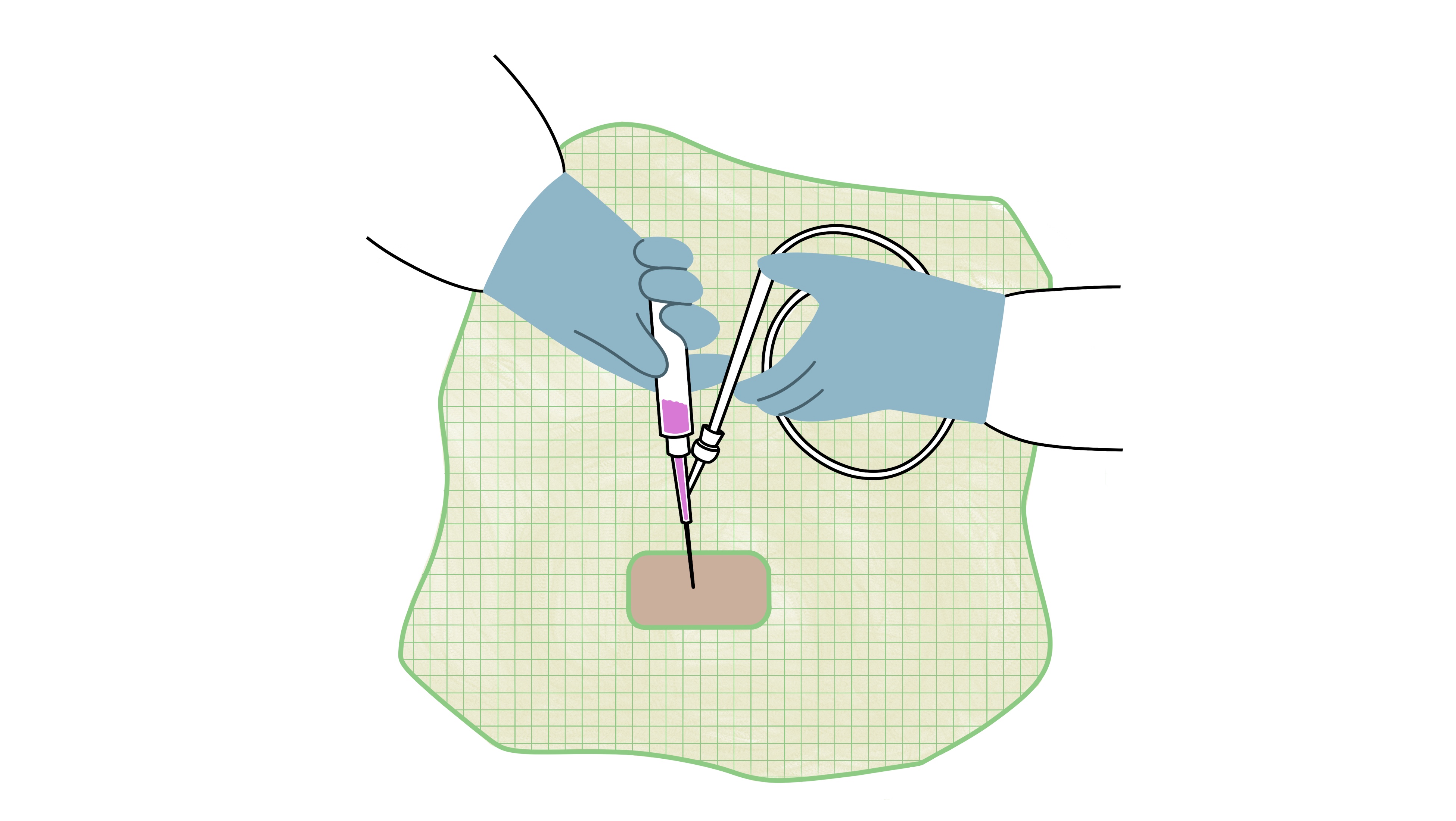 Die Illustration zeigt die assistierende Hand einer OTA während einer Operation.