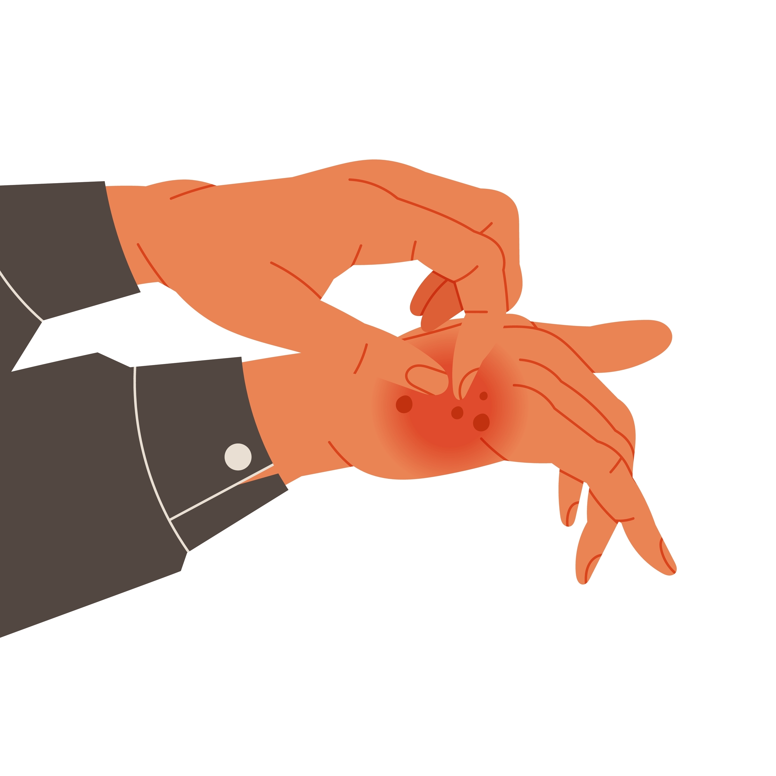 Neurodermitis, auch als atopische Dermatitis oder atopisches Ekzem bekannt, ist eine chronische Hauterkrankung. Die Illustration zeigt eine Hand die die andere an Neurodermitis erkrankte Hand kratzt.